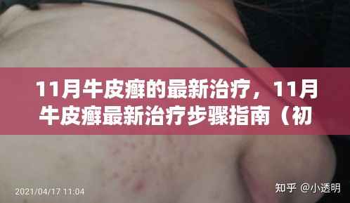 11月牛皮癣最新治疗指南,初学者与进阶用户适用的步骤和策略